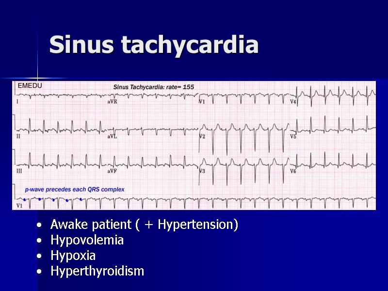 Sinus tachycardia Awake patient ( + Hypertension) Hypovolemia Hypoxia Hyperthyroidism